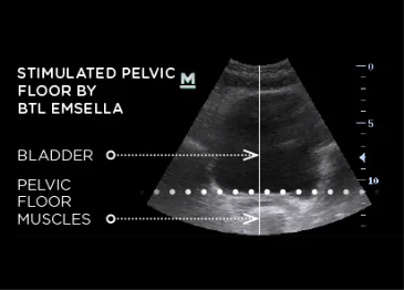 Stimulated Pelvic Floor by BTL Emsella