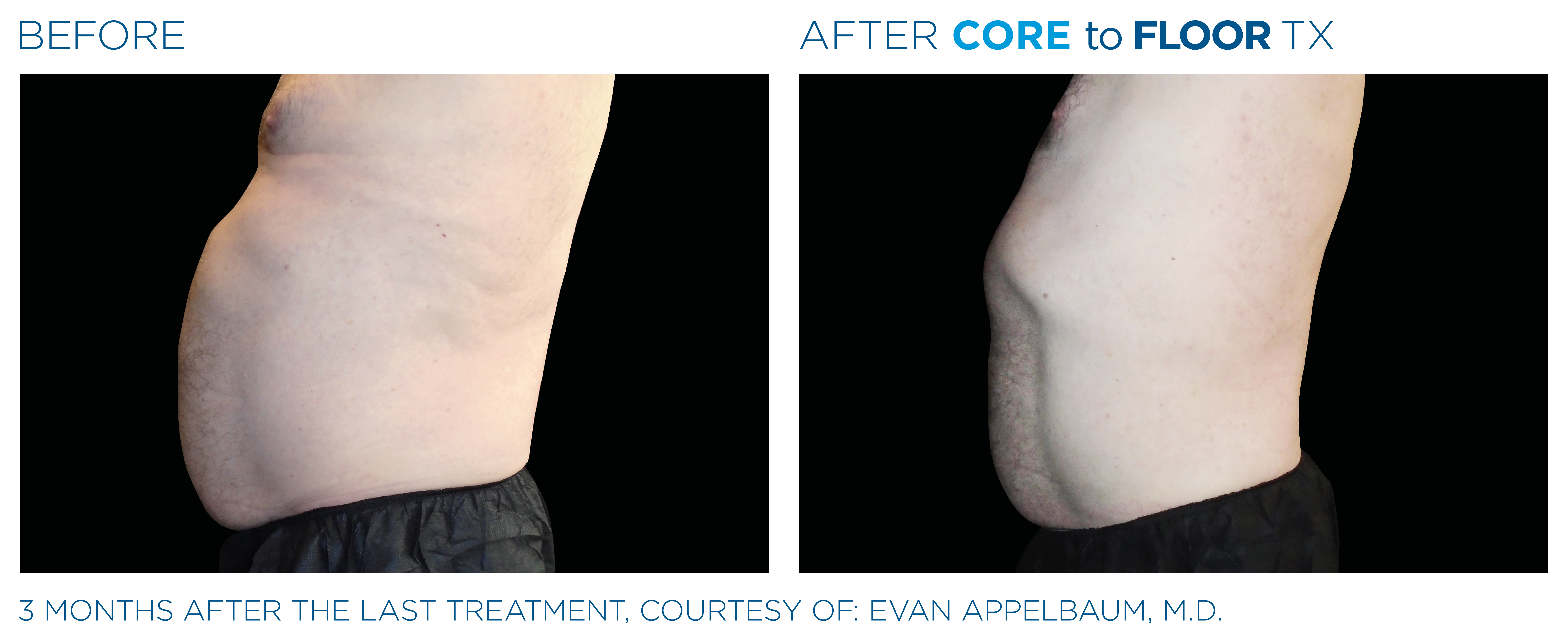 Before and After Emsculpt NEO for Abs