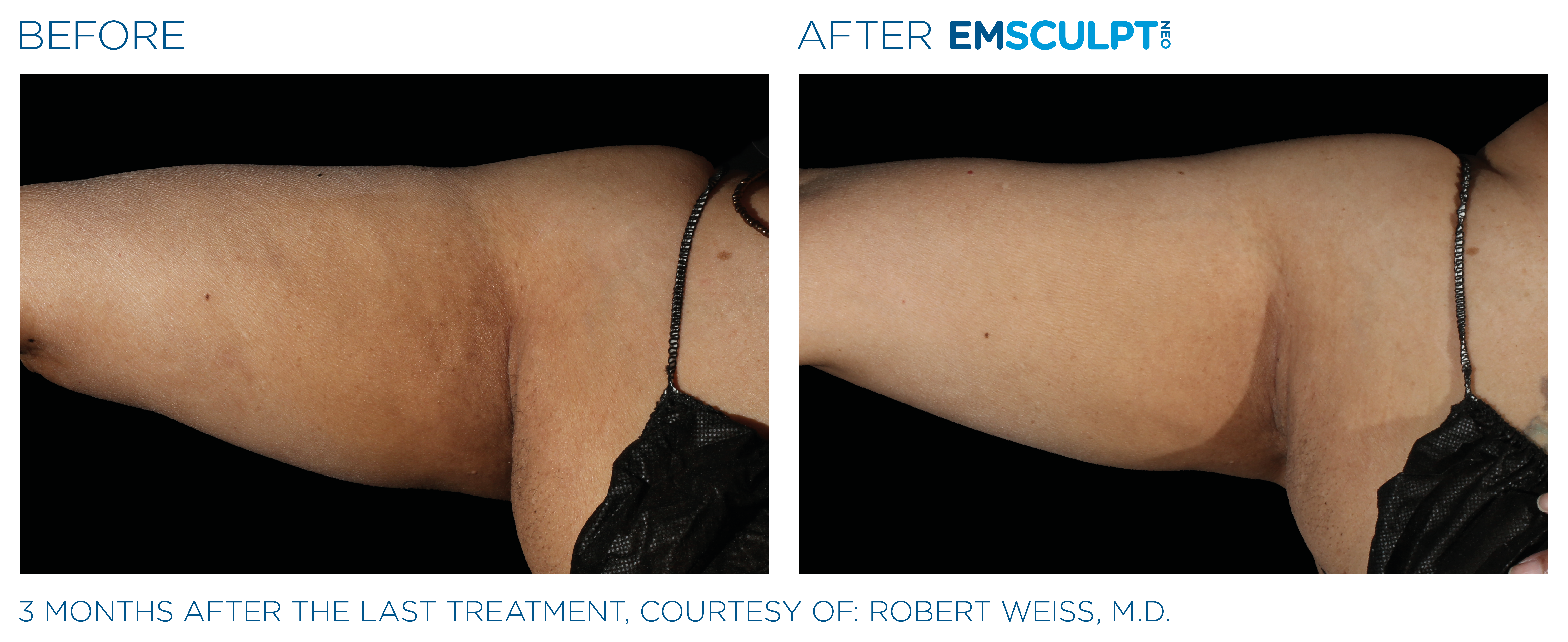 Before and After Emsculpt NEO for Arms