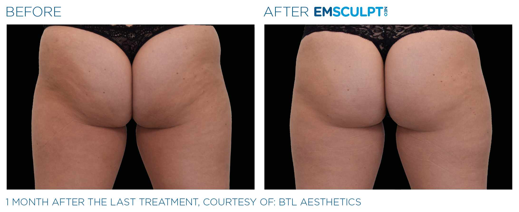 Before and After Emsculpt NEO for Butt