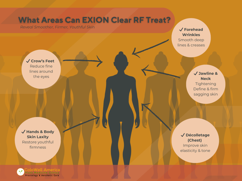 Exion Clear RF areas of treatment