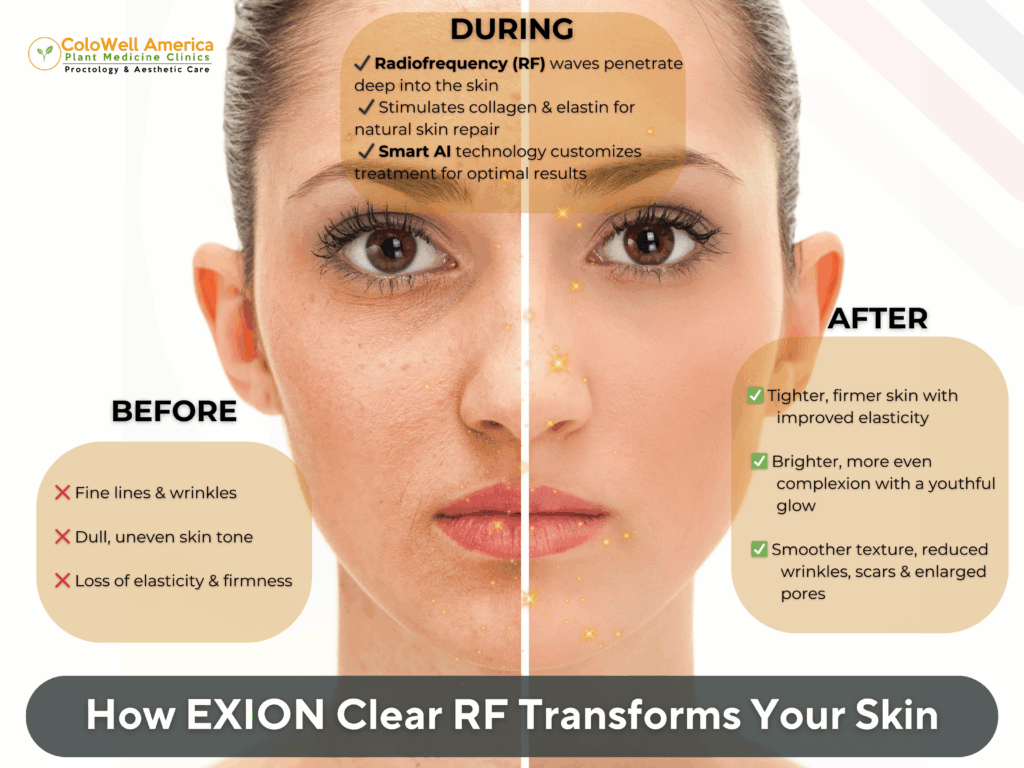 Exion Clear RF benefits