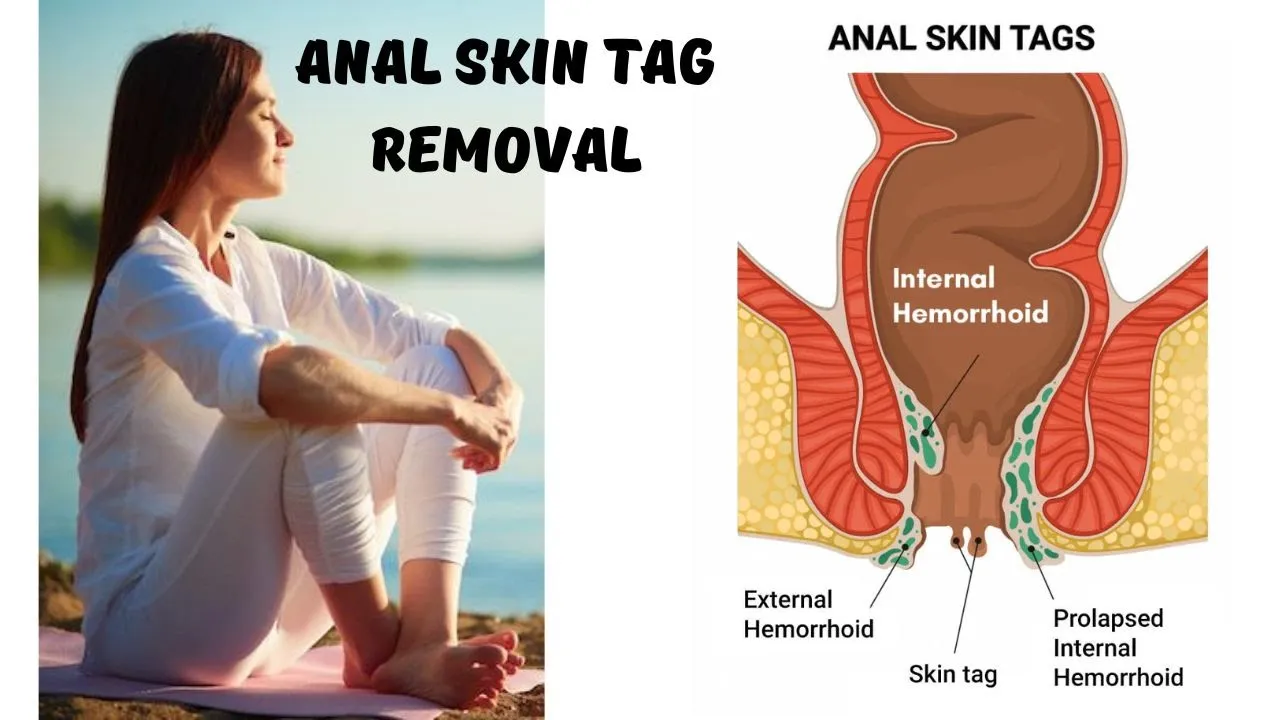 How To Get Rid Of Anal Skin Tags