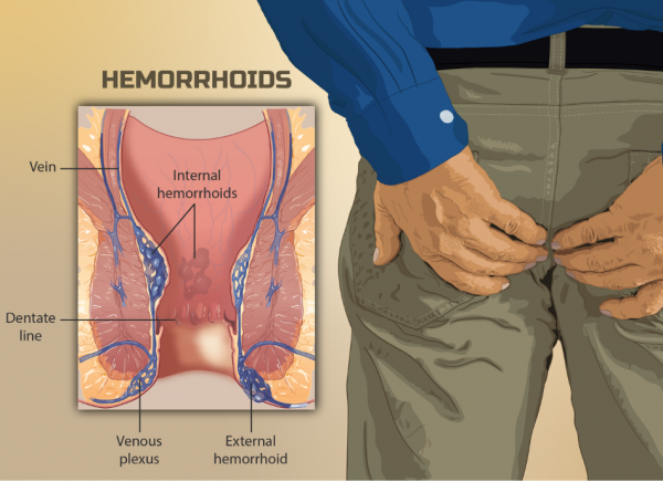 hemorrhoids labeled diagram with a man holding his butt in pain