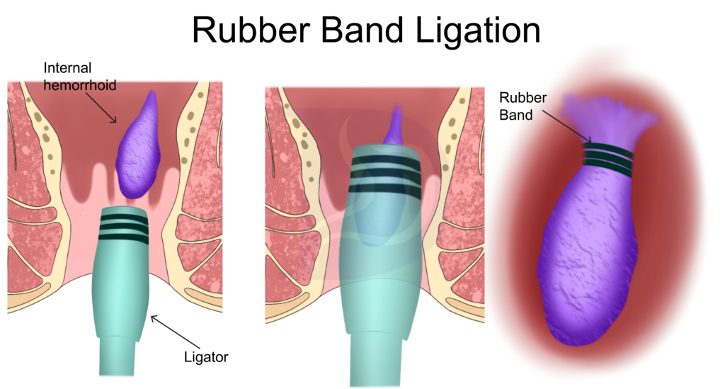 5 Recovery Tips For After Your Hemorrhoid Banding Surgery 3 hemorrhoid banding surgery illustration