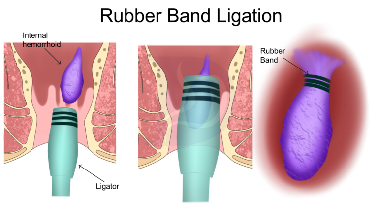 hemorrhoid banding surgery illustration