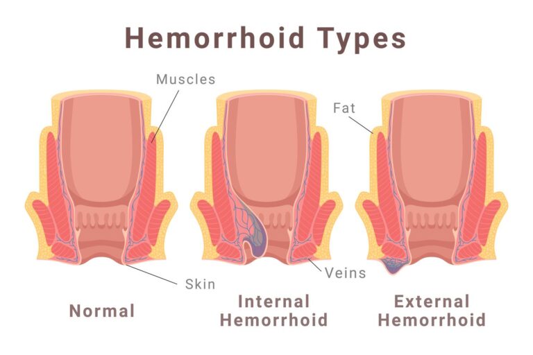 types of hemorrhoids illustration