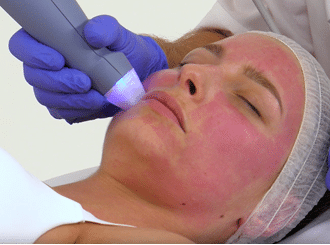 Exion Clear RF treatment