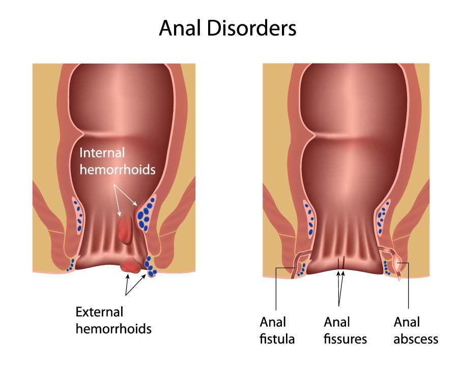 Perianal Abscess vs. Hemorrhoids: Key Differences 2 perianal abscess vs hemorrhoids illustration