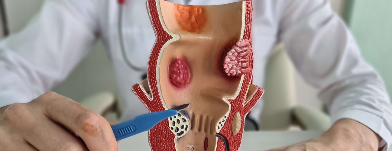 hemorrhoids illustration