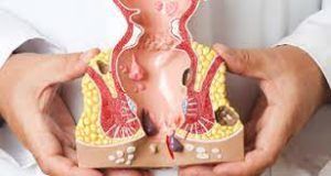 How Do I Know If I Have Hemorrhoids? 7 doctor pointing at figure of hemorrhoids