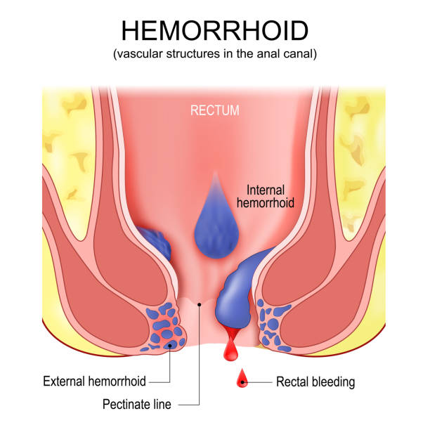 Could Your Hemorrhoid Symptoms Be a Sign of Something More Serious? 6 hemorrhoids illustration