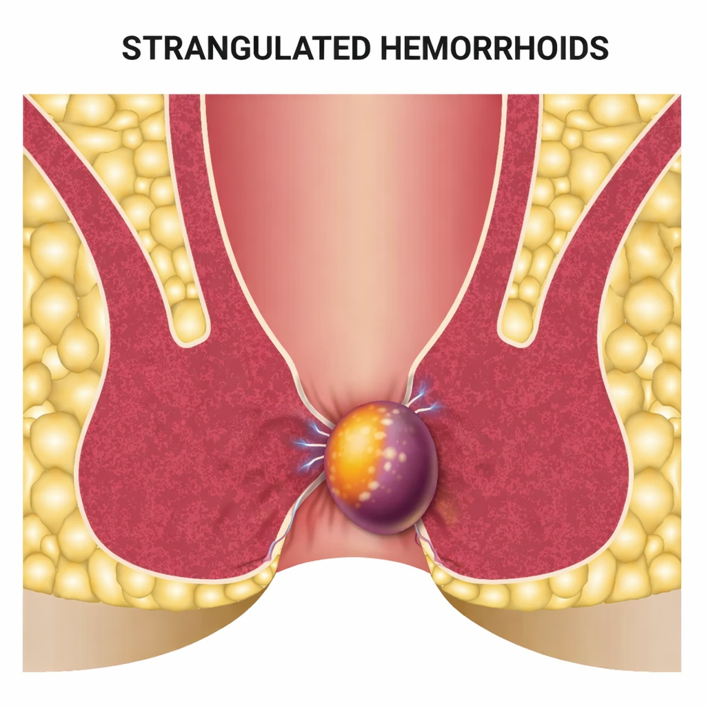 Strangulated Internal Hemorrhoids