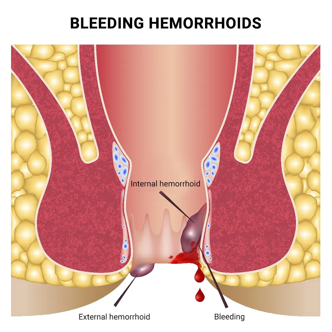 Bleeding/Burst Hemorrhoids illustration