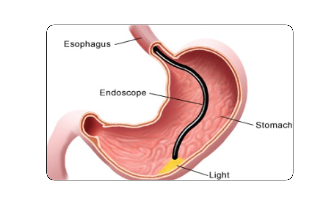 Upper Endoscopy (EGD) with Biopsy