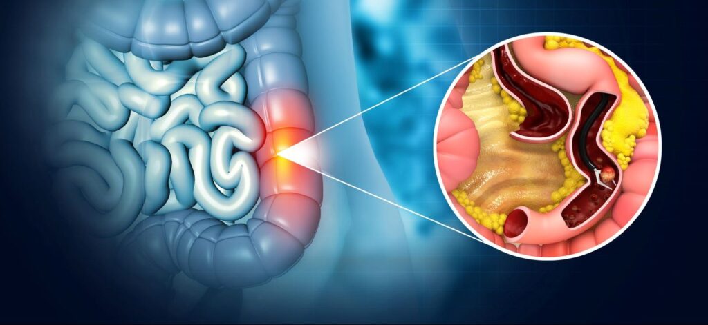 colon polyps detection illustration