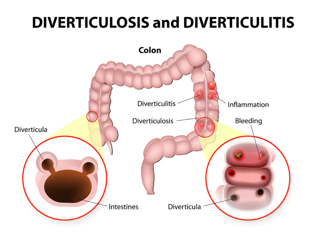 diverticulitis illustration